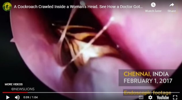 한 여성의 코에 바퀴벌레가 들어가 의학적으로 빼내는 작업 동영상 [사진=영국 해충박멸업체 멜린 MERLIN 캡처]