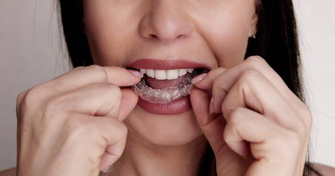 마우스피스는 치아 위아래 본을 떠 단단한 소재로 제작해서 사용해야 한다. [사진=게티이미지뱅크]