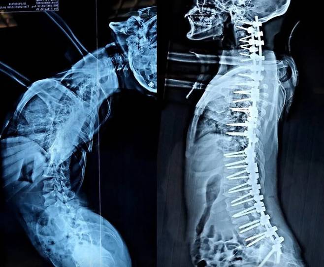 수술 전후 엑스레이 사진 [사진='더선' 보도내용 캡처]