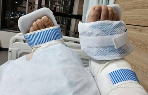 병원의 실수로 양다리가 모두 불구가 된 A씨[연합. A씨 제공]