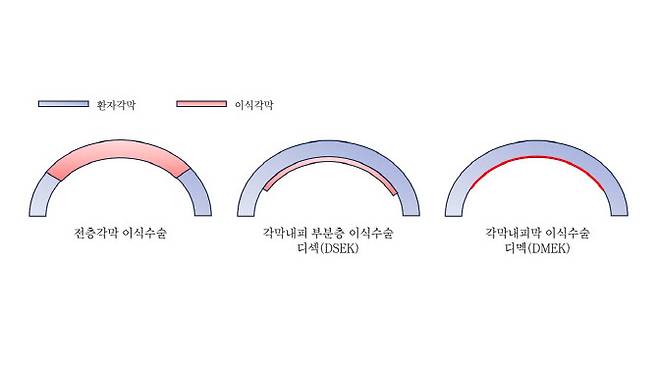 각막내피이식 디멕수술 모식도.