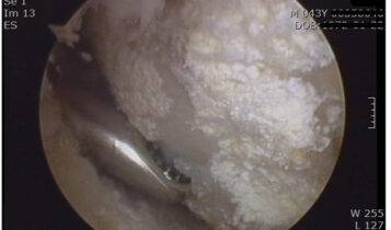 무릎 관절에 생긴 통풍 내시경 소견. 흰색 요산결정체가 연골에 박혀있는 것이 보인다. [사진=송무호 제공]