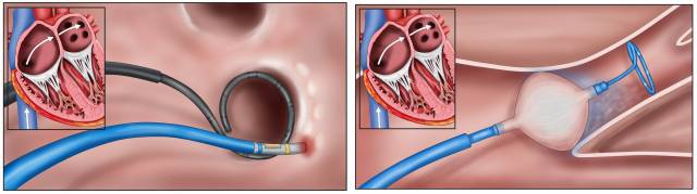 고주파 전극도자 절제술(왼쪽)과 풍선 냉각도자 절제술 모식도. 사진 제공=삼성서울병원