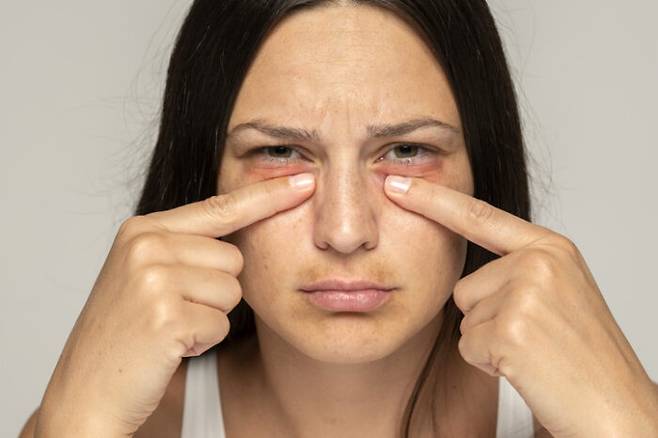 눈 밑이 떨리는 현상은 마그네슘이 부족하면 나타나는 것으로 알려져 있지만 꼭 그렇지만은 않다. [사진=게티이미지뱅크]