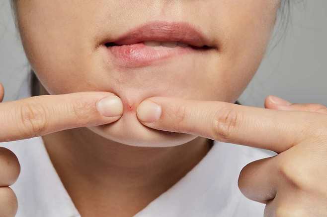 비타민 B5는 피부 건강에 도움을 주는 성분이긴 하나, 피지분비량을 줄여 여드름을 개선한다고 보기는 어렵다.  /게티이미지뱅크