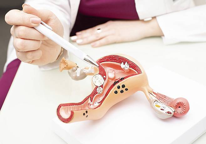 세포 노화가 난소암 확산을 촉진한다는 연구 결과가 나왔다./사진=클립아트코리아