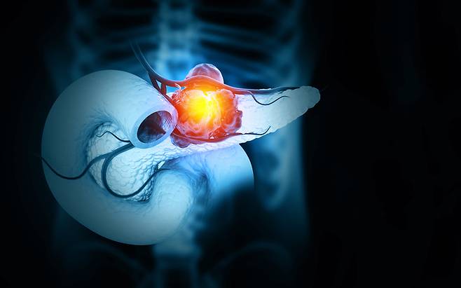 미국암학회(ACS)의 2024년 통계에서 췌장암 5년 생존율은 13%로 가장 낮았다. 하지만 10년 전 췌장암의 5년 생존율이 6%였던 것과 비교하면 두 배 넘게 상승한 것이다. [사진= 게티이미지뱅크]