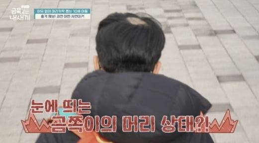 채널 A '요즘 육아-금쪽같은 내새끼' 방송에서 나온 발모광 환자의 사례. 원형 탈모처럼 두피 일부가 드러나 있다. /사진=채널 A '요즘 육아-금쪽같은 내새끼' 방송 화면 캡처