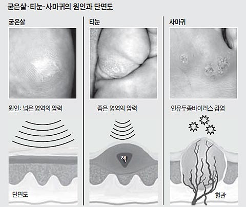 굳은살과 티눈, 사마귀는 모두 얼핏 보면 비슷해서 겉모습이나 촉감으로는 구분하기 어렵다./사진=헬스조선DB