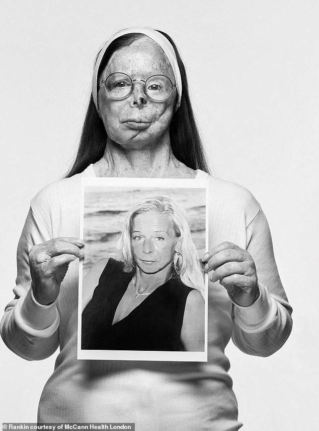 2009년 황산 테러로 화상을 입은 파트리시아 르프랑(59)이 ‘눈물의 쿠튀르’ 화보집에 출연한 모습. [산 테러 생존자 국제 신탁]