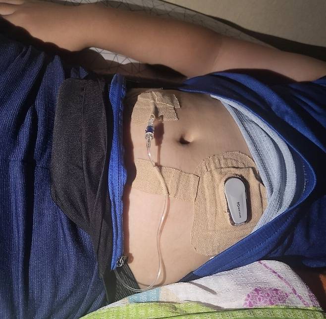 준서 배에 붙어 있는 연속혈당측정기(오른쪽 아래)와 인슐린 자동주입기(왼쪽 위). 조명실 제공