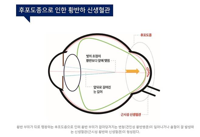 근시의 진행/ 세브란스병원 제공