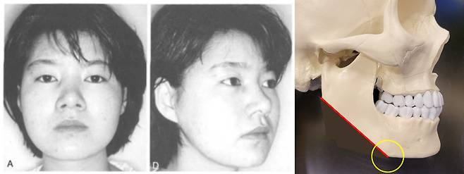 각을 잘라도 정면 효과가 크지 않고, 기존 각 부위 앞으로 새로운 각(2차 각, 노란 동그라미) 가 생기는 것을 보여주는 1995년 논문. 박철규 등. [사진=Aesthetic Plastic Surgery volume 19,93(1995)]