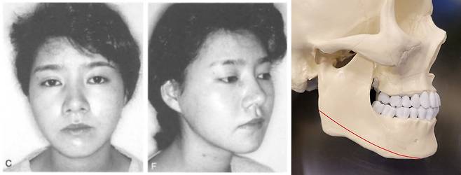 중요한 것은 '각'이 아닌 '각도'였다. 현재는 턱 선의 '각도'를 줄여주는 수술이 시행된다. [사진=Aesthetic Plastic Surgery volume 19,93(1995)]
