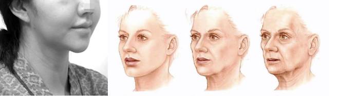 현재 발생하는 '개 턱'느낌은 귀밑각 때문이 아닌 경우가 대부분이다. 살이 늘어진 데 주원인이 있으므로, '노화'와 유사한 양상을 보인다.