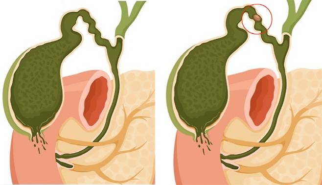 무결석성 급성담낭염(왼쪽)과 결석성 급성담낭염. 자료제공=한림대의료원