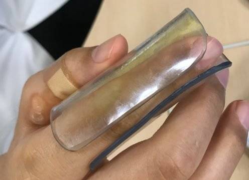 세계 유일의 전신마비 치과의사인 분당서울대병원 이규환 교수는 본인이 직접 만든 도구를 검지 손가락에 끼고 진료를 본다. 단순해 보이지만 10여 번 업그레이된 소중한 도구다. [사진 이규환]