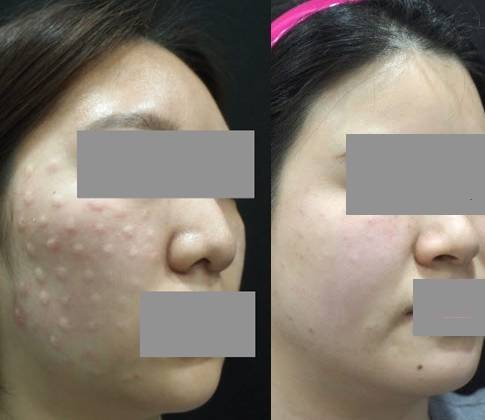 (좌)리쥬란 시술 후 (우)리쥬란HB 시술 후. 리쥬란 시술 후에는 엠보싱 자국이 생길 수 있는데, 이는 하루 이틀 내에 사라진다./사진=아름다운나라피부과 제공