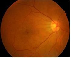 망막전막이 있는 오른쪽 눈의 안저(눈의 안쪽 표면) 사진.