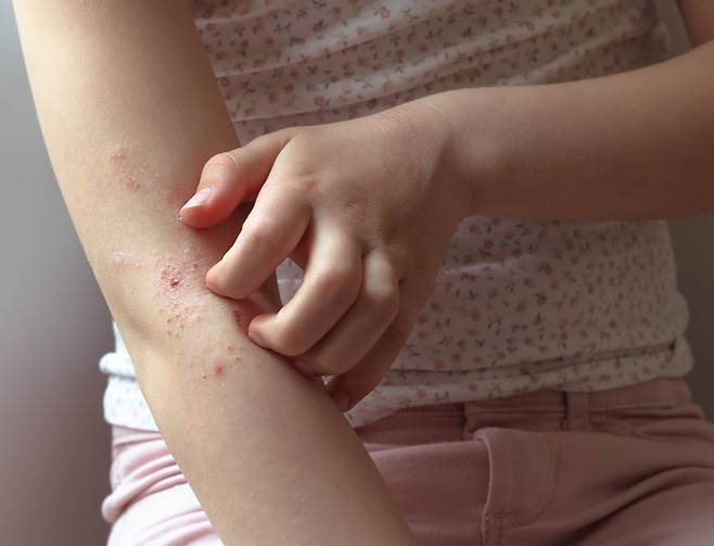 아토피 피부염 등 만성 피부질환이 있는 아이가 학습, 기억력 장애를 겪을 위험이 큰 것으로 나타났다.[사진=게티이미지뱅크]