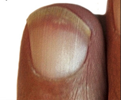 Terry's nail./사진=The American Journal of Medicine