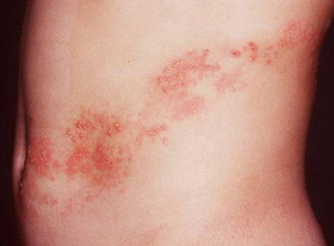 몸통 부위에 띠 모양으로 발생한 대상포진. 국가건강정보포털 제공