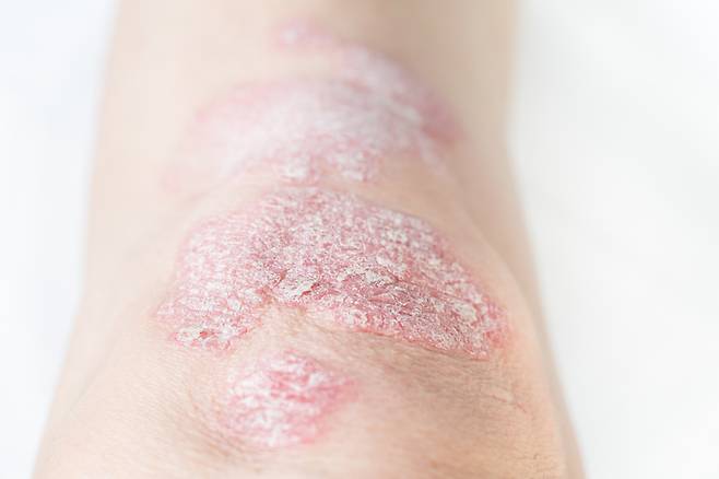 건선은 피부에 은백색 비늘로 덮인 붉은 빛을 띠고 가려운 반점을 유발한다. 일부 환자의 경우엔 관절통, 붓기, 경직 등이 특징인 건선 관절염이 발생하기도 한다. [사진= 게티이미지뱅크]