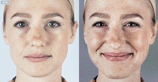 웃을 때 중요하게 작용하는 근육은 큰 광대근(Zygomaticus major, 그림의 민트색) 입니다.  [이미지=Anatomy of Facial Expression 제공]