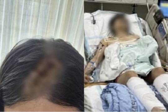 피해자 측이 밝힌 피해자의 부상 사진. 온라인 커뮤니티 캡처