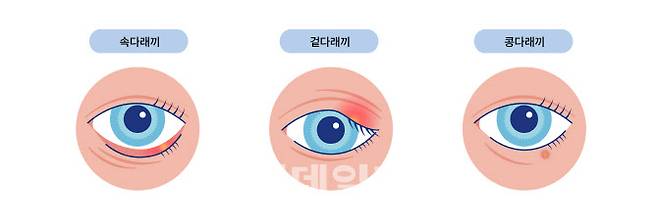 다래끼의 종류 (자료=보건복지부 블로그)