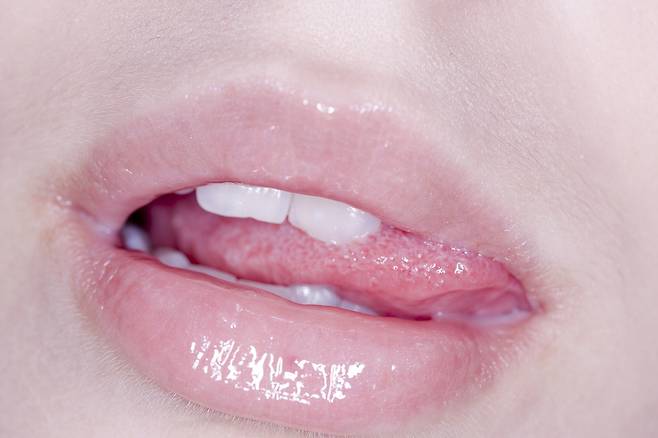 혓바늘을 빨리 없애려면 충분한 휴식을 취하고, 영양 상태를 잘 관리해 면역력을 회복해야 한다./사진=클립아트코리아