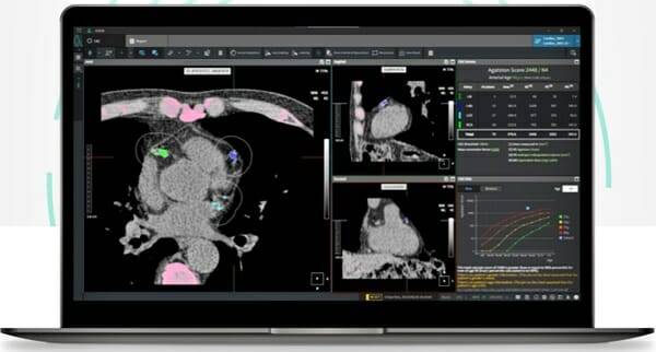 AVIEW CAC 화면(출처=코어라인소프트 홈페이지 캡처)