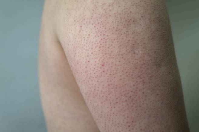 닭살과 뱀살을 없애려면 피부 보습을 철저히 해야 한다./사진=게티이미지뱅크