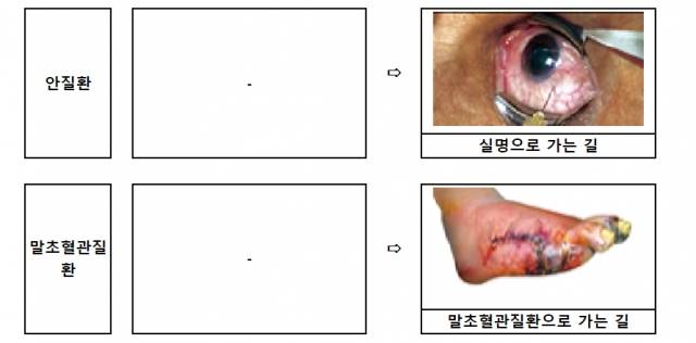 오는 12월 담뱃값에 추가되는 안질환과 말초혈관질환 경고 그림. 보건복지부 제공