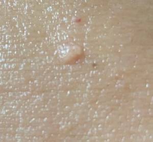 피지샘증식증./사진=헬스조선DB