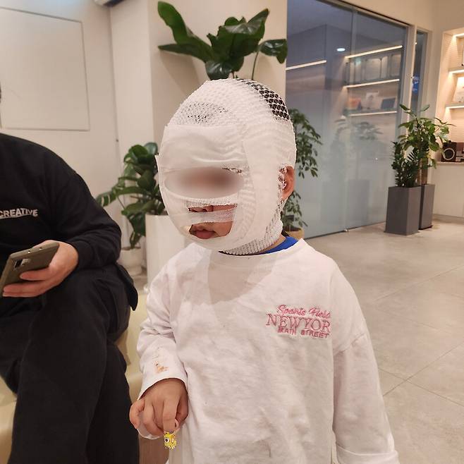 지난달 31일 경기 포천시 허브아일랜드에서 깡통열차 전복 사고로 얼굴이 땅에 갈린 하은(가명·3)이 모습. 엄마 김아무개(37)씨 제공.