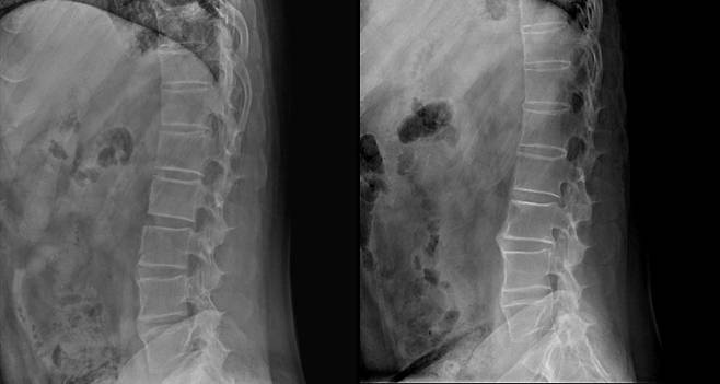 B씨의 척추를 찍은 X레이 사진. 2018년(왼쪽)에는 뼈 마디가 붙어있지 않았지만 지난해 사진에서는 대부분의 뼈 마디가 붙어버렸다. 서울아산병원 제공