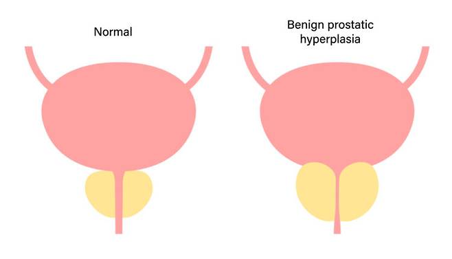 전립선비대증. [사진=클립아트코리아]