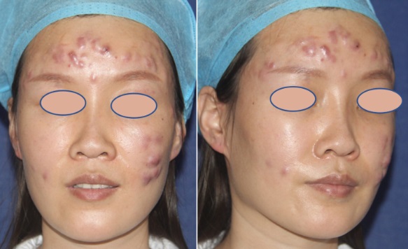 미용 주사를 맞은 후 비결핵 항산균(Mycobacterium chelonae) 감염으로 얼굴에 결절, 농양이 발생한 33세 동양인 여성의 모습./사진=임상사례보고