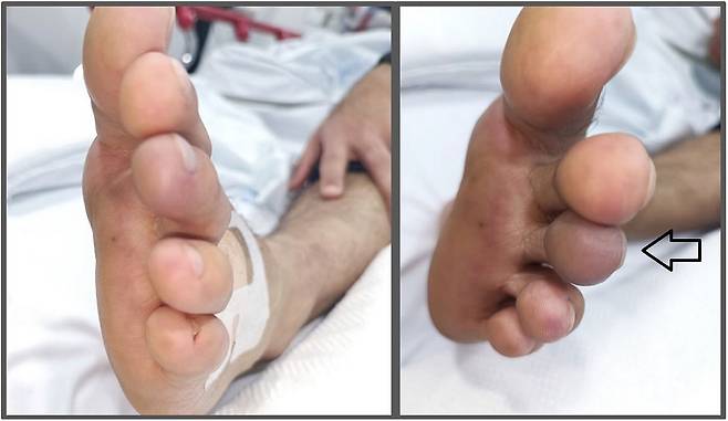 왼쪽 세 번째 발가락(화살표가 가리키는 부분)이 파랗게 변색되고 극심한 고통을 겪은 사우디 30대 남성의 사연이 공개됐다./사진=임상사례보고​
