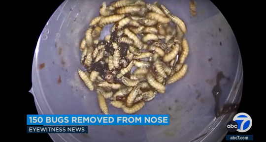 미국 플로리다 주에 거주하는 남성의 콧속에서 발견된 150마리의 파리 유충. 유튜브 캡처