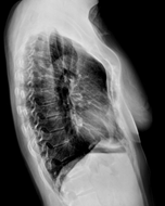 그림 2. 상부 새가슴