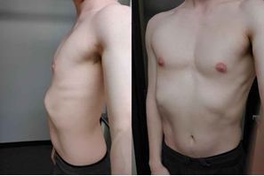 그림 3. 늑연골 돌출