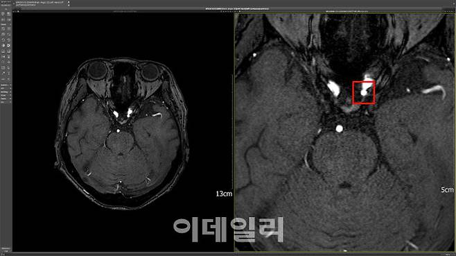 딥노이드의 뇌동맥류 검출 AI 솔루션 ‘딥뉴로’ 판독 이미지 (자료=딥노이드)