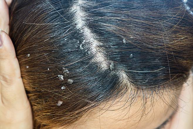 비듬 전용 샴푸로 머리를 감아도 비듬이 개선되지 않는다면 모낭염으로 인한 각질이 원인일 수 있다./사진=게티이미지뱅크
