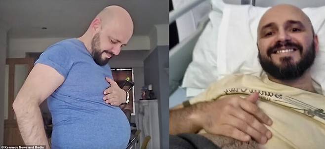 사진 속 남성은 작년 4월 대장에 생긴 게실을 치료하는 수술을 받고 두 달이 지나자 배가 점점 부풀면서 탈장이 생겼다. 탈장은 몸의 장기가 제자리에 있지 않고 돌출되는 현상이다. [사진=영국 매체 데일리메일/Kennedy News and Media]