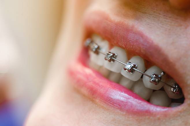치아 교정은 치아의 대칭을 맞추고 교합을 개선하는 치료법으로, '안면 비대칭'에 미치는 영향은 미미합니다. [사진=게티이미지뱅크]