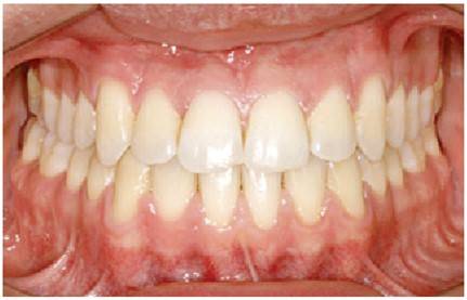 양악 수술로 치아의 치아의 비대칭과 부정교합이 크게 좋아졌습니다. (Press J Orthod. 2018 Nov-Dec; 23(6): 80)