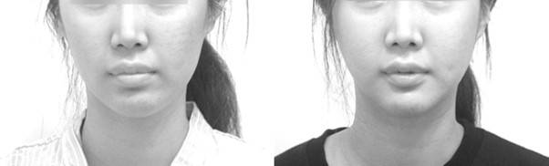 턱끝의 비대칭을 교정하는 것만으로 입술의 비대칭이 함께 좋아진 모습.