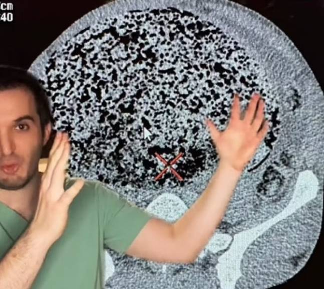 의사가 손으로 표시하고 있는 까만색, 흰색이 섞인 커다랗고 둥근 부분이 배 속에 가득찬 똥이다. [데일리메일]